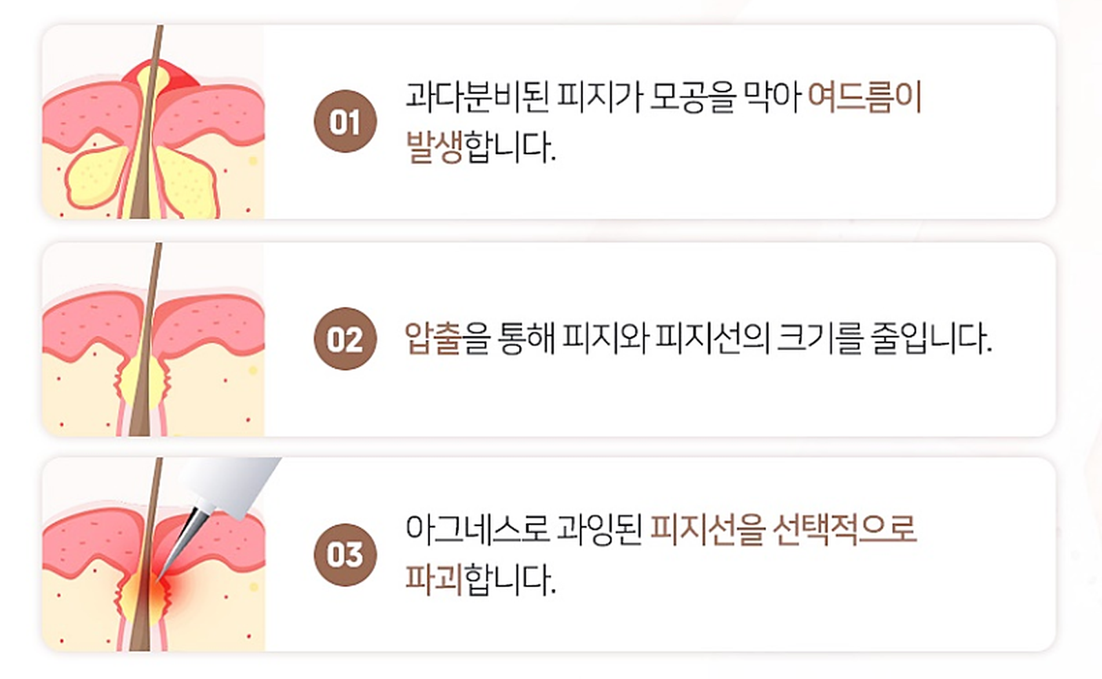 압출 후 아그네스 RF로 과잉 피지선을 선택적으로 관리하는 원리