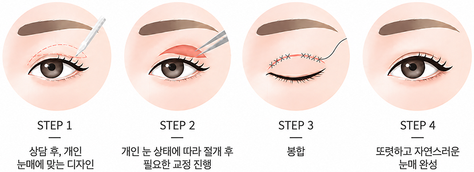 상안검 수술 4단계: 개인 눈매에 맞는 디자인, 절개 후 필요한 교정, 봉합, 자연스러운 눈매 완성