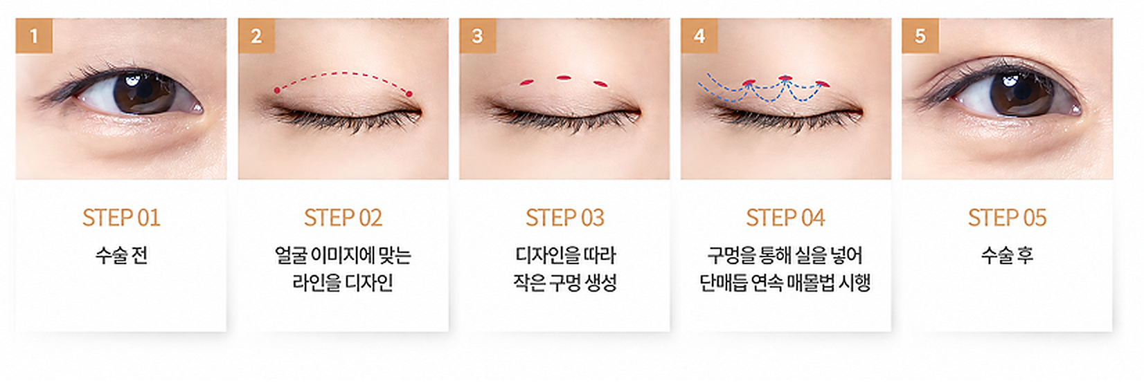 매몰법 5단계: 수술 전, 라인 디자인, 작은 구멍 생성, 실을 넣어 단매듭 연속 매몰법 시행, 수술 후