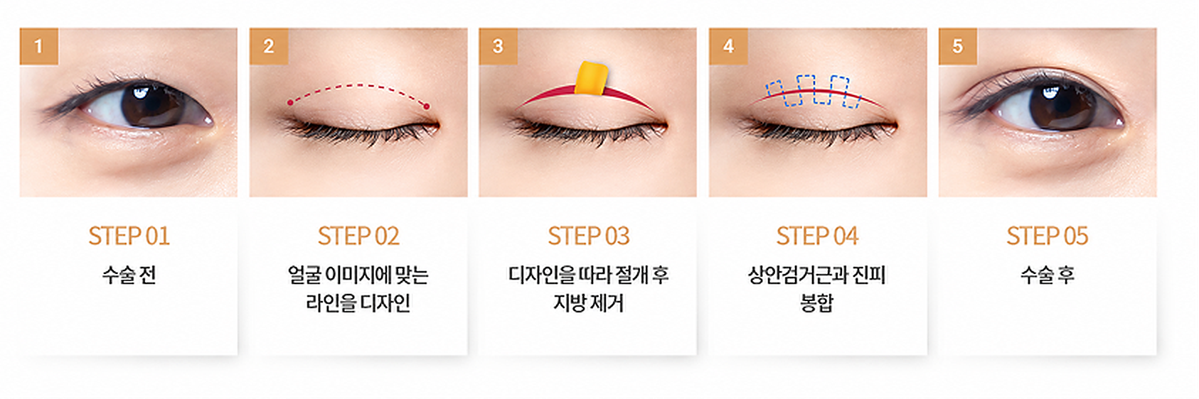 절개법 5단계: 수술 전, 라인 디자인, 절개 후 지방 제거, 상안검거근과 진피 봉합, 수술 후