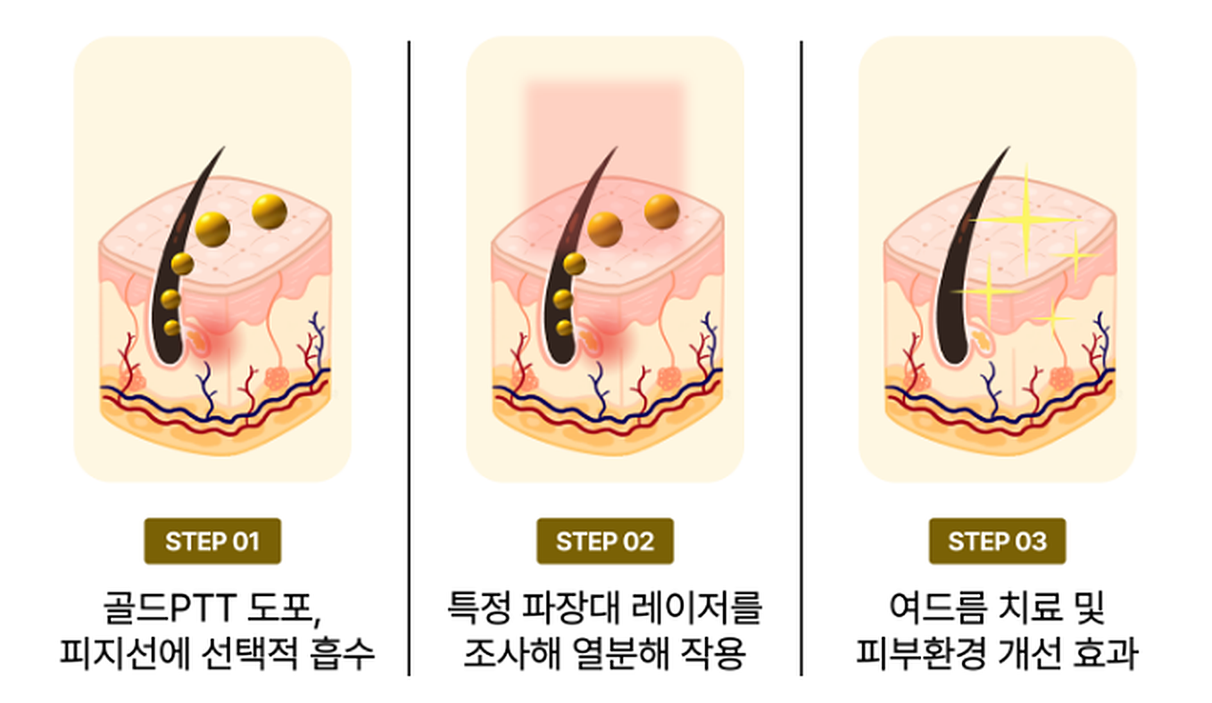 골드 입자 도포와 레이저 열 반응으로 이어지는 골드 PTT 원리
