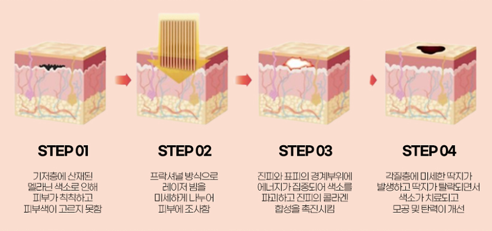 라비앙 BB 레이저의 멜라닌 색소 반응과 자연 탈락 과정