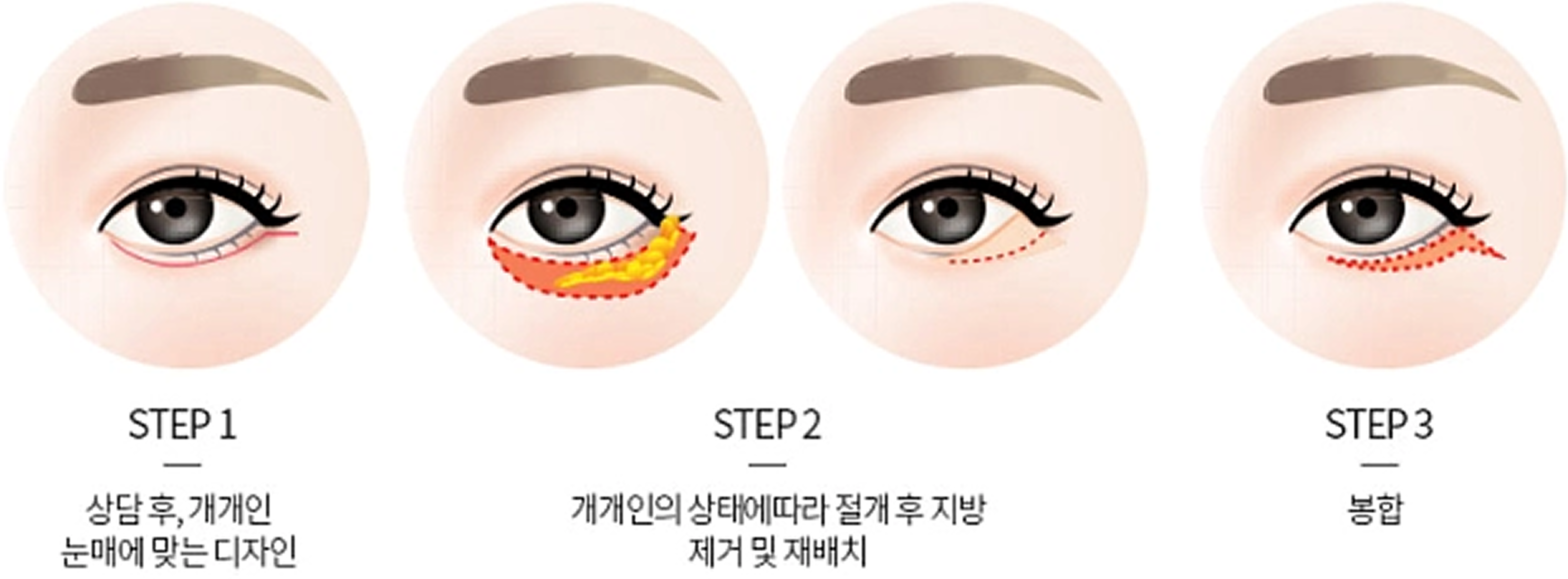 하안검 수술 3단계: 개인 눈매에 맞는 디자인, 절개 후 지방 제거 및 재배치, 봉합
